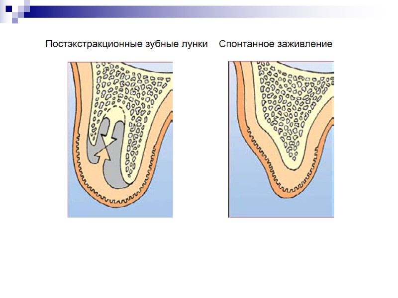 Постэкстракционные зубные лунки    Спонтанное заживление  НКР/НРТ/Мягкая ткань